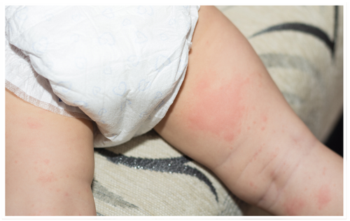 Baby Rash Relief